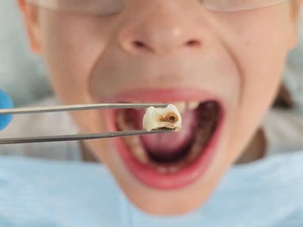 Best Tooth Infection Emergency Dentist  in Wilmer, TX